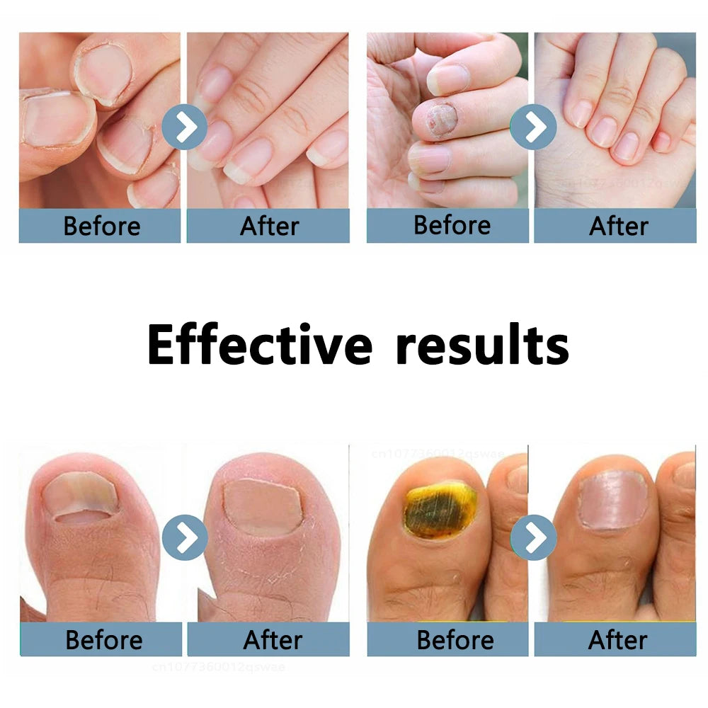 Nail Fungus Cleaning Light Device Onychomycosis